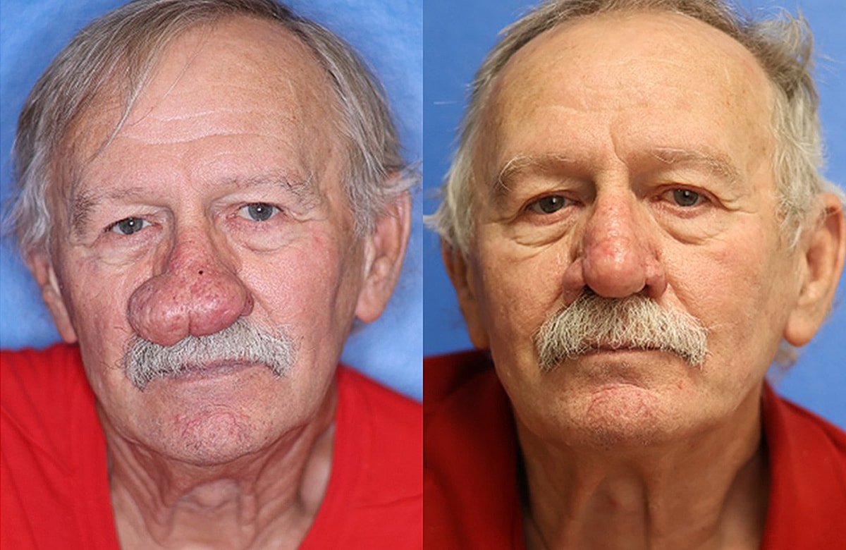 Rhinophyma Before & After