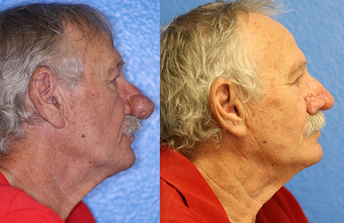 Rhinophyma Before & After