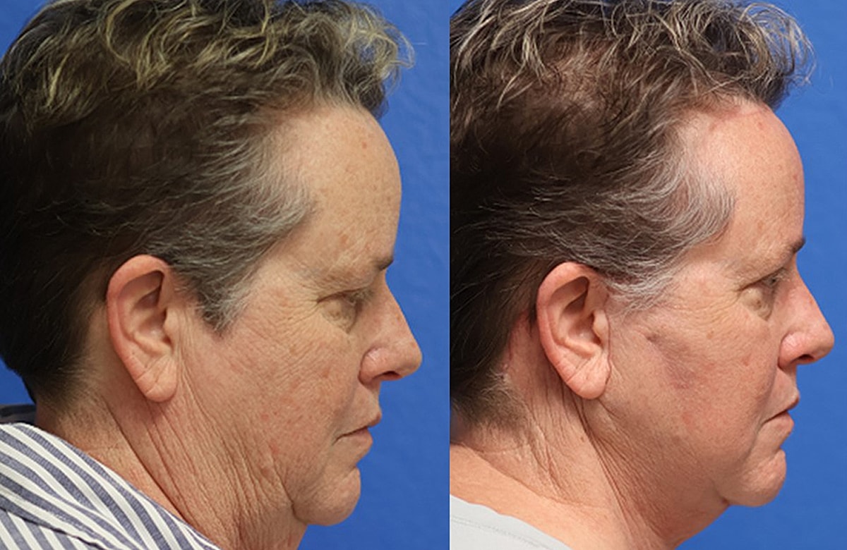 Face & Neck Lift Before & After