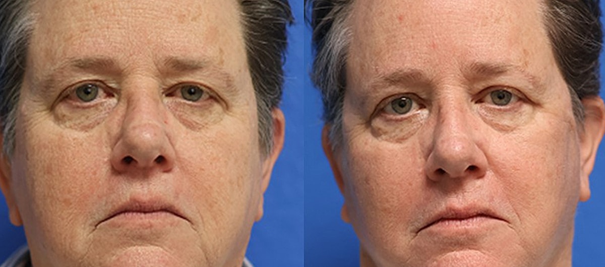 Brow Lift Before & After