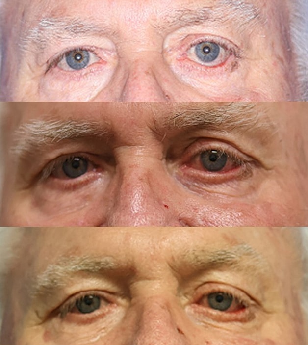 Ectropion Before & After