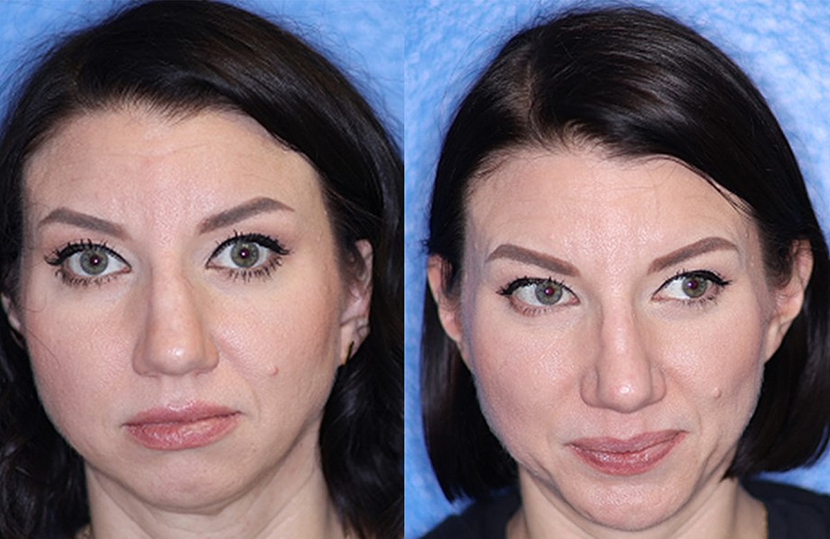 Rhinoplasty Before & After