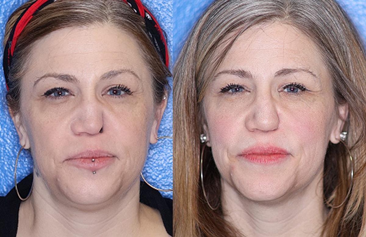 Rhinoplasty Before & After