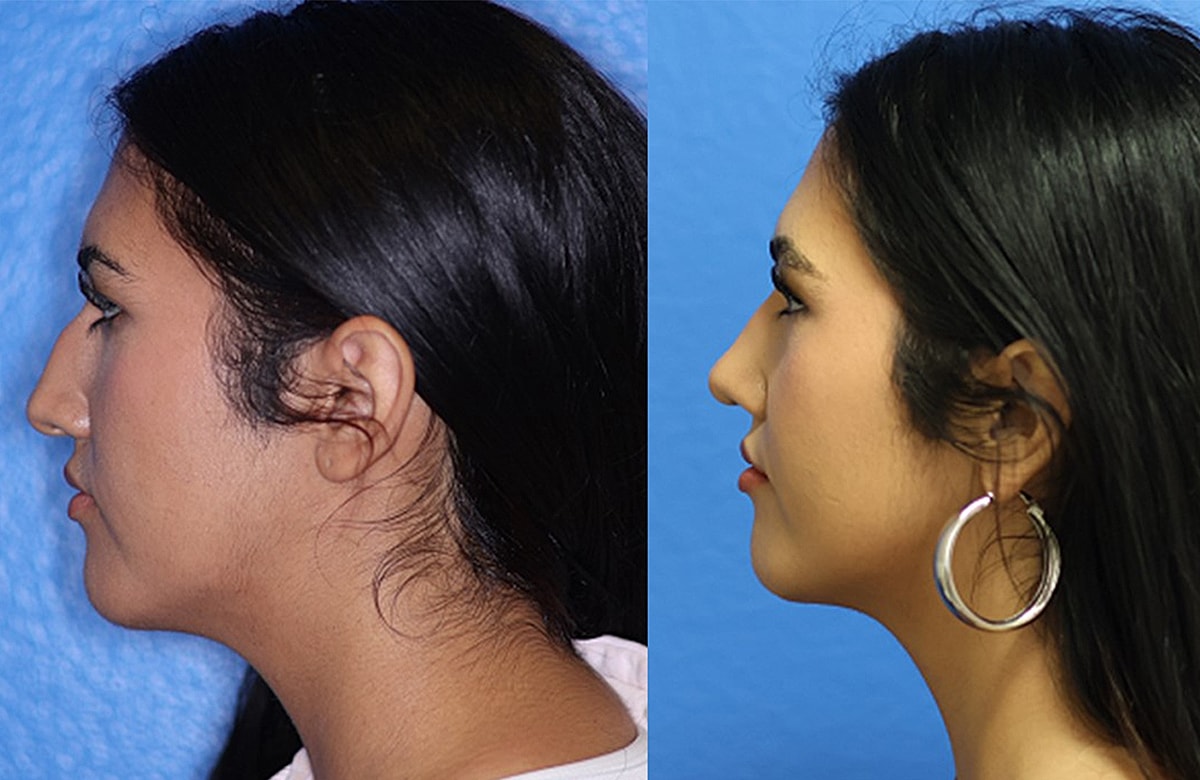 Rhinoplasty Before & After