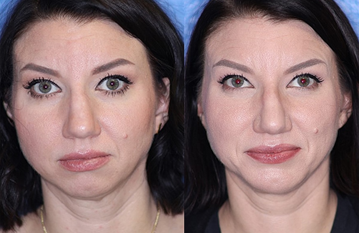 Before & After