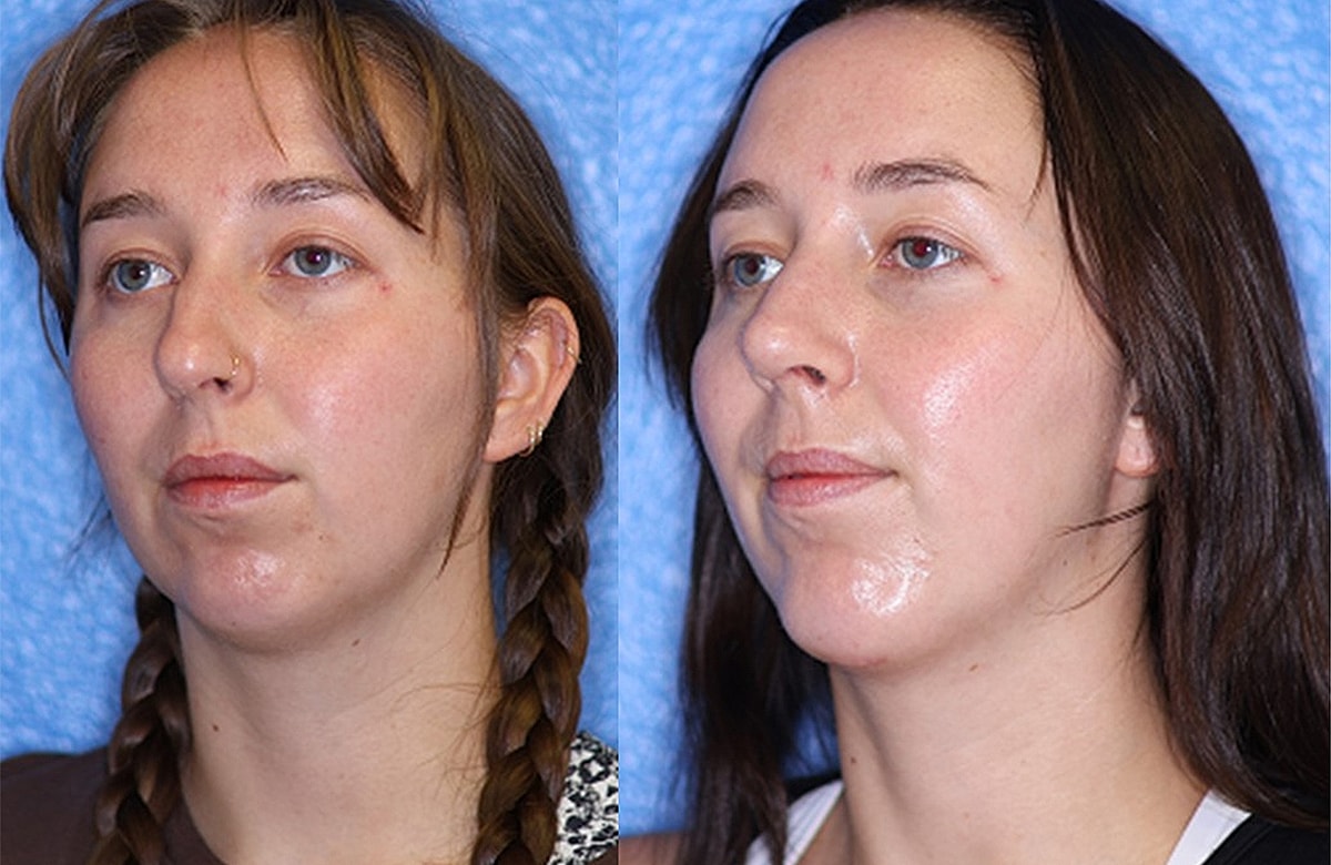 Before & After