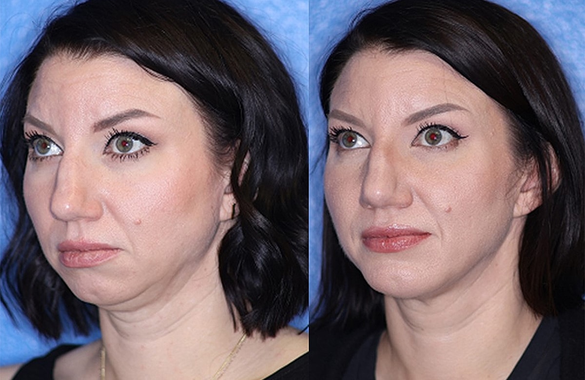 Before & After