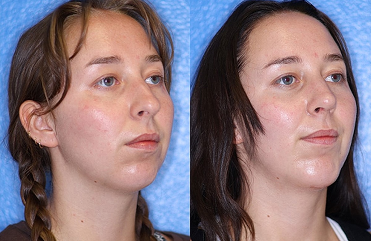 Before & After