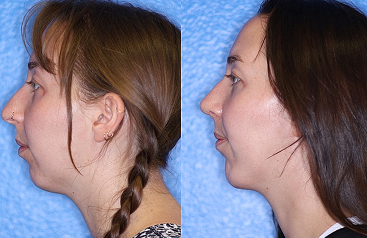 Chin Augmentation Before & After