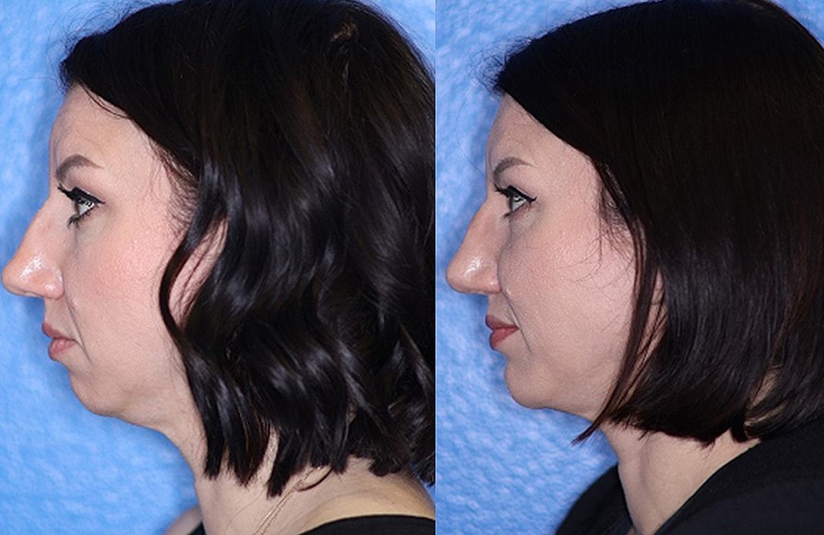 Chin Augmentation Before & After
